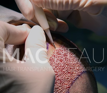 Greffe de Cheveux Anesthésie Sans Aiguille et Avec Technique du Stylo DHI Sans Rasage