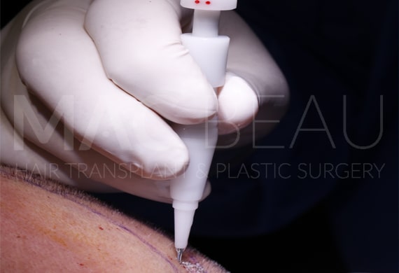 Greffe de Cheveux DHI